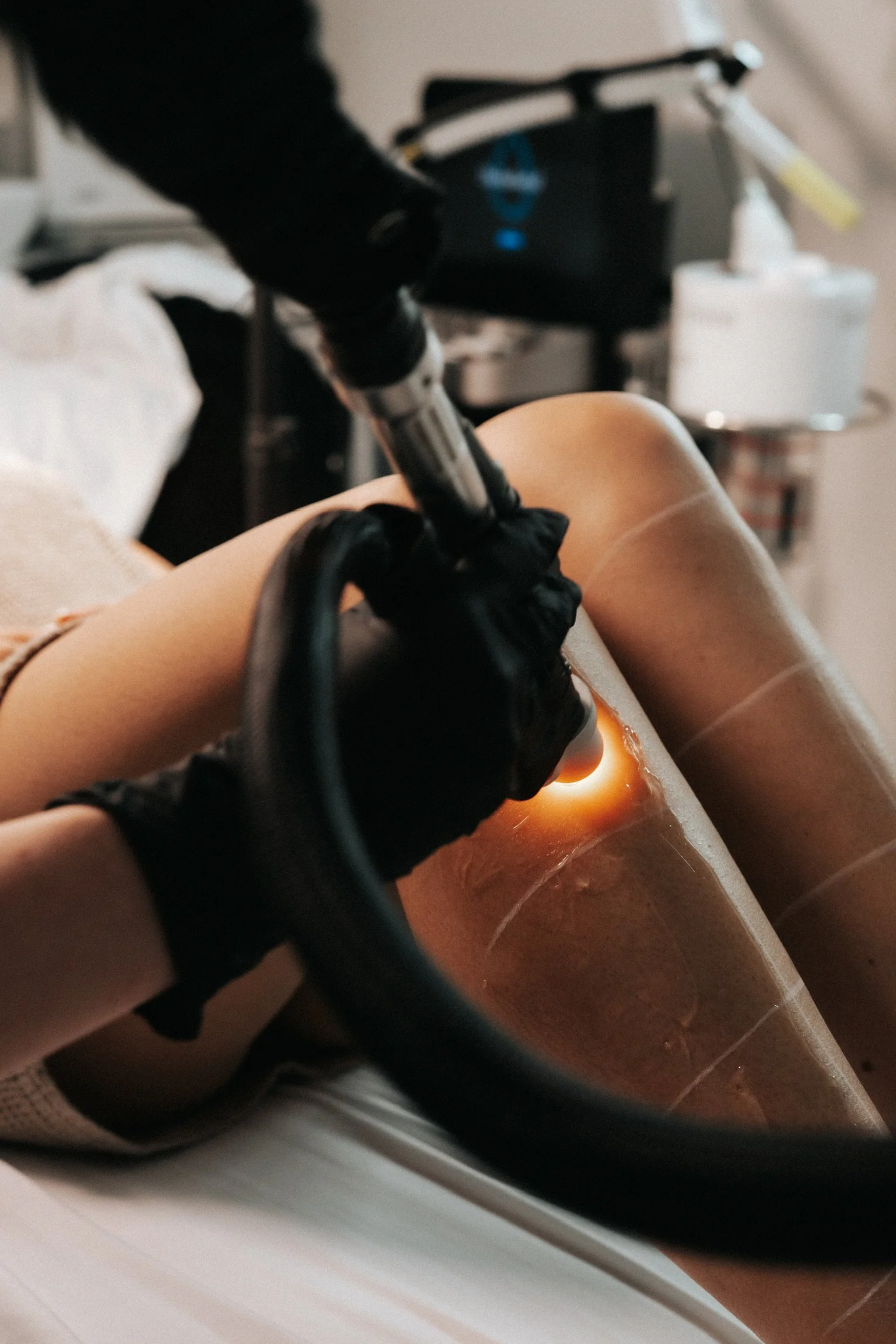 laser hair removal centennial