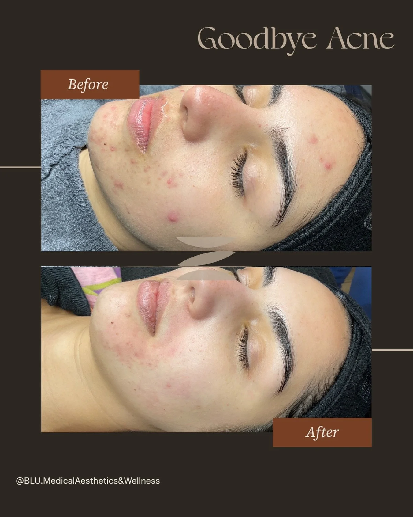 Goodbye acne&hellip; hello confidence ✨

This transformation is what happens when you stop chasing surface-level fixes and start treating the root cause.

We combined advanced aesthetics + internal wellness for real, lasting results:
Aerolase Acne Bo