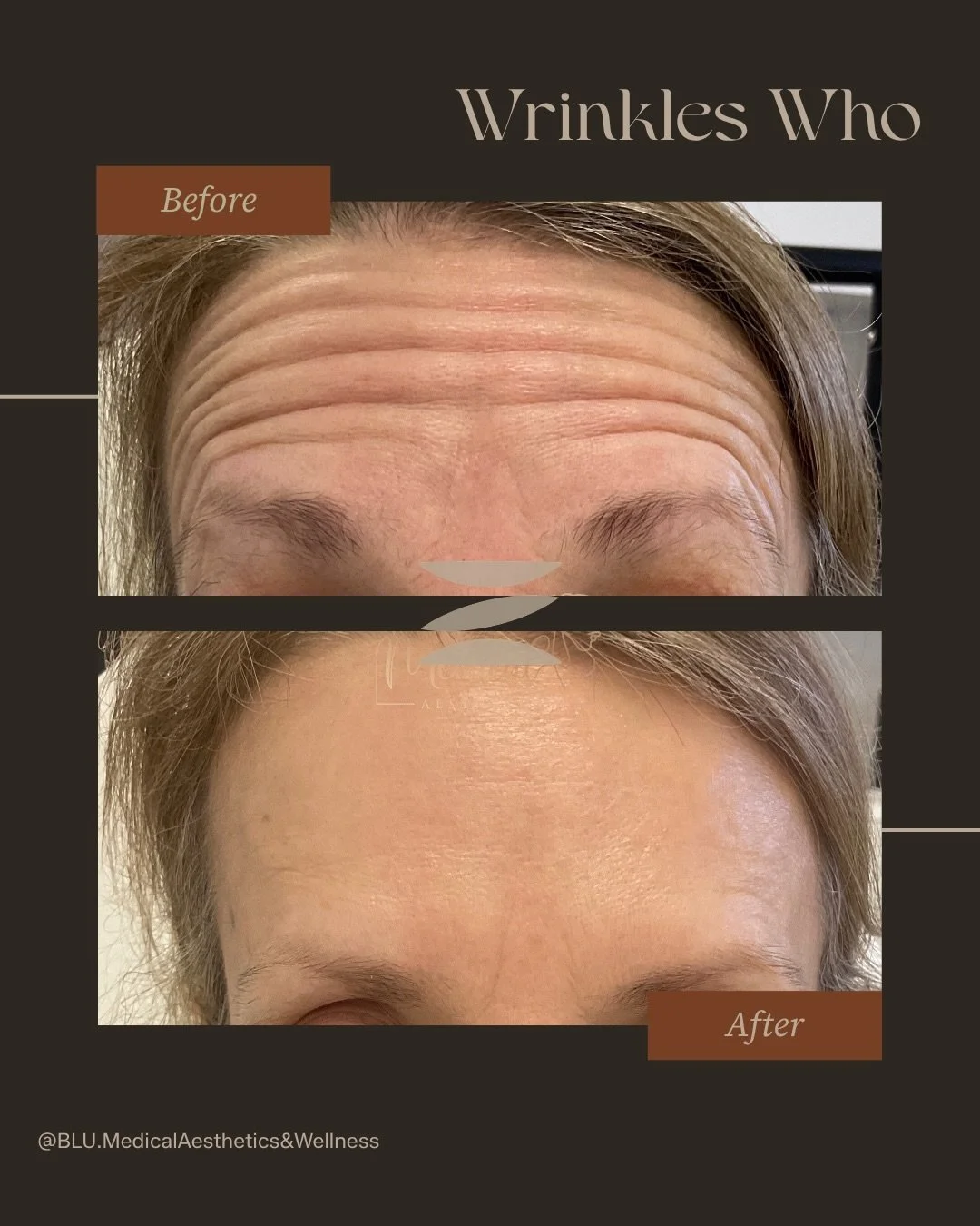 Wrinkles who? ✨

These before and after results are the perfect example of what happens when you treat the cause of wrinkles, not just the surface. Smooth, refreshed, and still completely natural.

Forehead lines and frown lines (11&rsquo;s) soften b