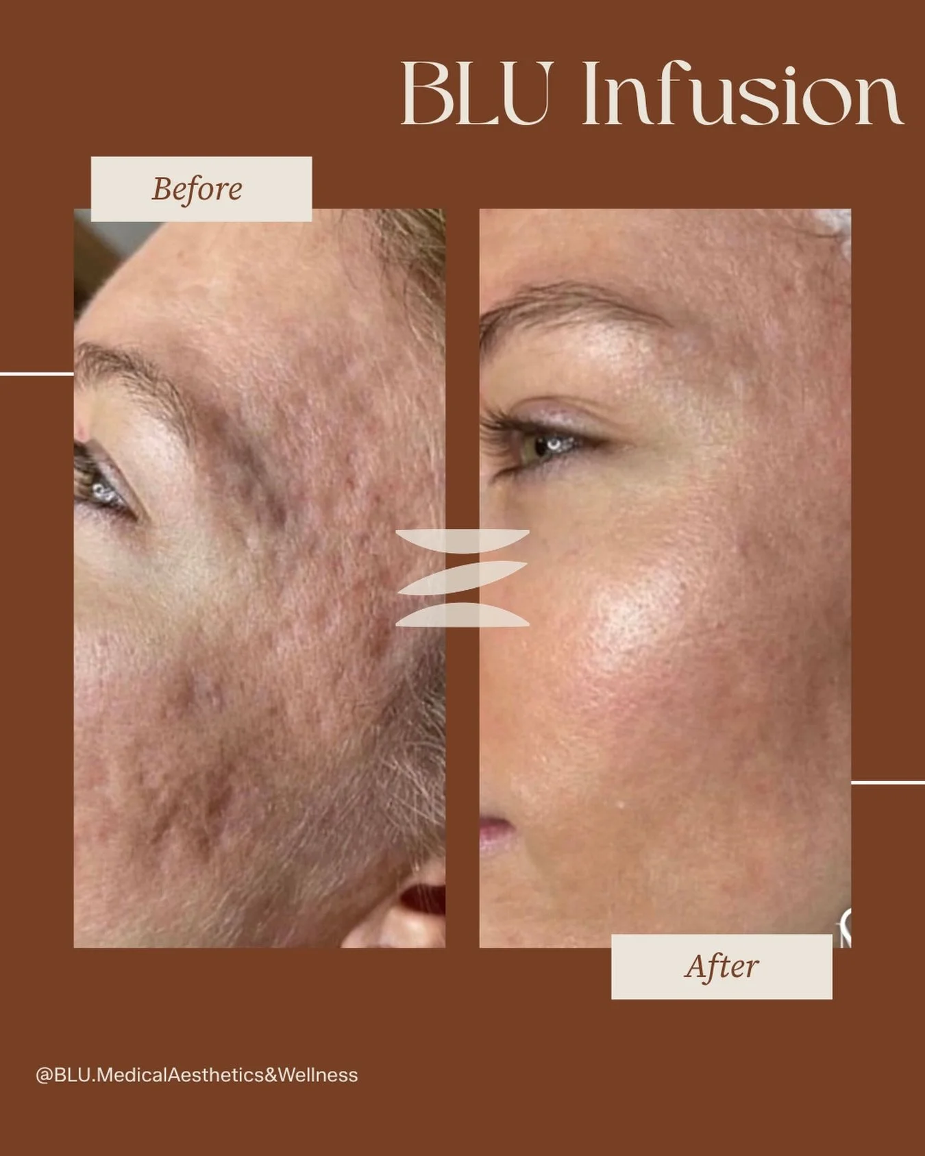 BLU Infusion is not your average microneedling treatment ✨

This is where advanced aesthetics meets regenerative wellness 🧬

Unlike traditional microneedling that focuses on creating micro-injuries to stimulate collagen, BLU Infusion takes it a step