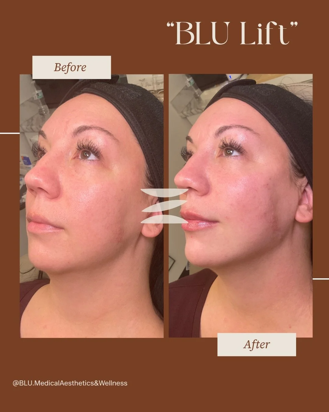 Full facial balancing is where artistry meets precision ✨

Our signature BLU Lift&trade; is designed to enhance your natural features&mdash;not change them. By strategically placing dermal filler + biostimulators + Neurotoxins , we restore harmony, i