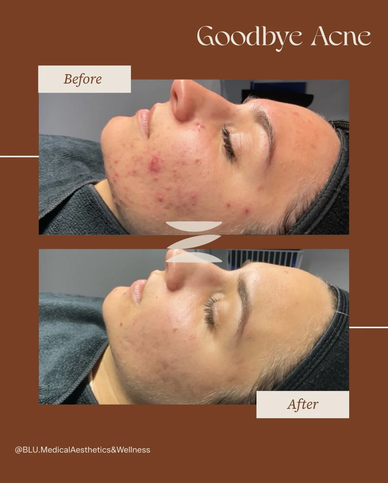 At BLU, each of our skincare providers is a certified acne specialist. We take a holistic approach to acne treatment, focusing on more than just the surface of the skin to address the root causes and support long-term skin health. ✨

🤍 How we cleare