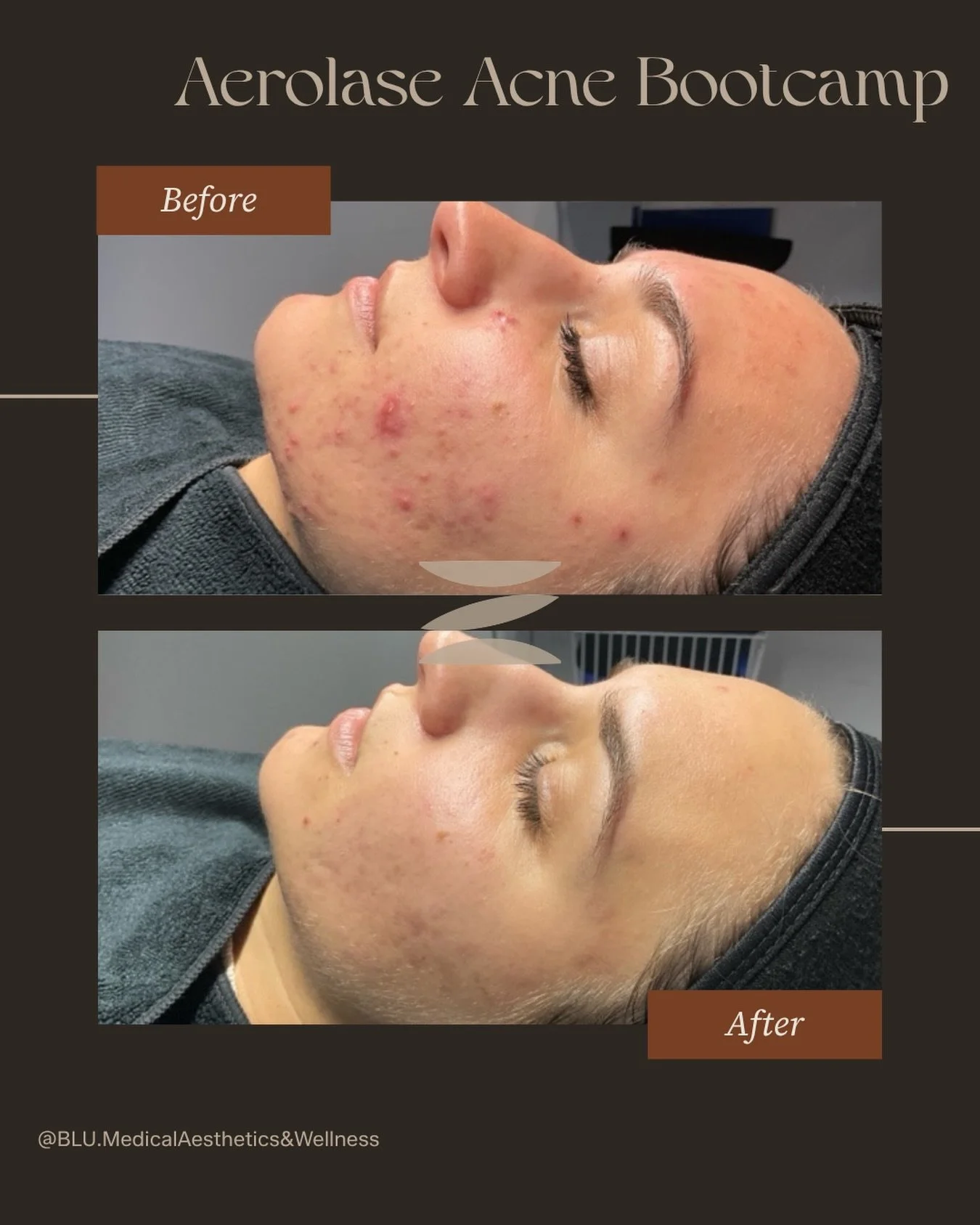 Clear skin isn&rsquo;t just luck&hellip; it&rsquo;s a plan 🤍✨

This transformation is from our custom Aerolase Acne Boot Camp &mdash; a customized series combining the power of Aerolase laser + targeted acne chemical peels to treat breakouts at the 