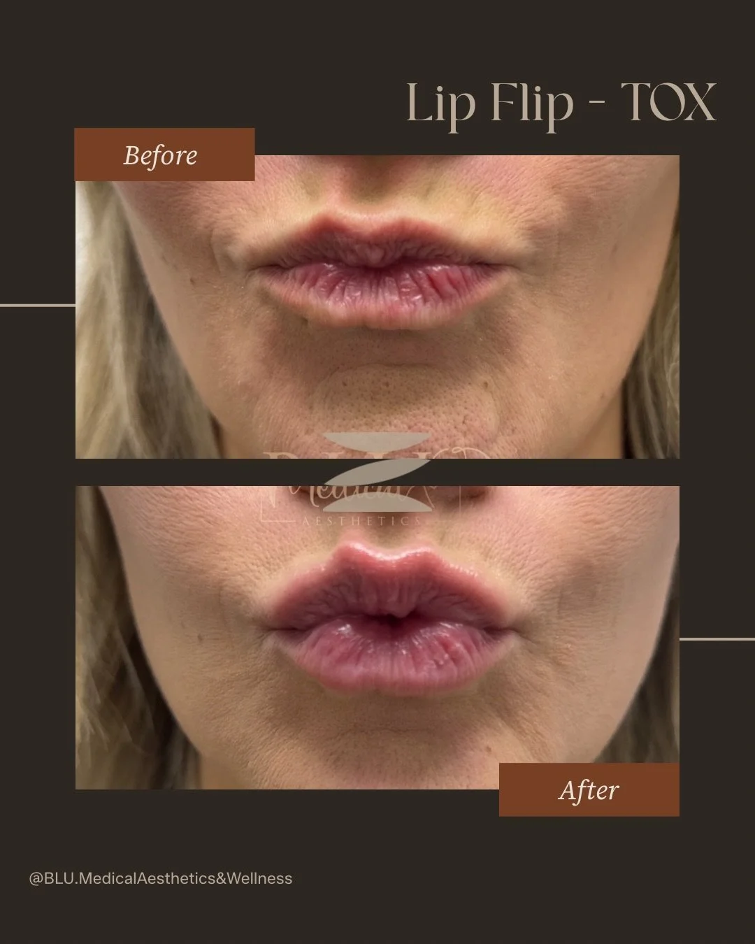 Subtle, natural, and beautifully enhanced 💉✨

These results are from a Lip Flip using TOX&mdash;one of our favorite ways to enhance the lips without adding volume.

Here&rsquo;s the difference 👇

Lip Flip (TOX):
A small amount of neurotoxin is plac