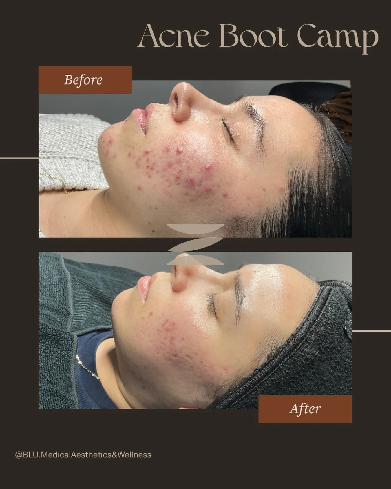 Acne isn&rsquo;t one-size-fits-all&hellip; so your treatment shouldn&rsquo;t be either 🤍

At BLU, we offer two customized Acne Boot Camp options depending on your skin, severity, and goals:

✨ Option 1: Acne Peel Boot Camp
Perfect for mild to modera