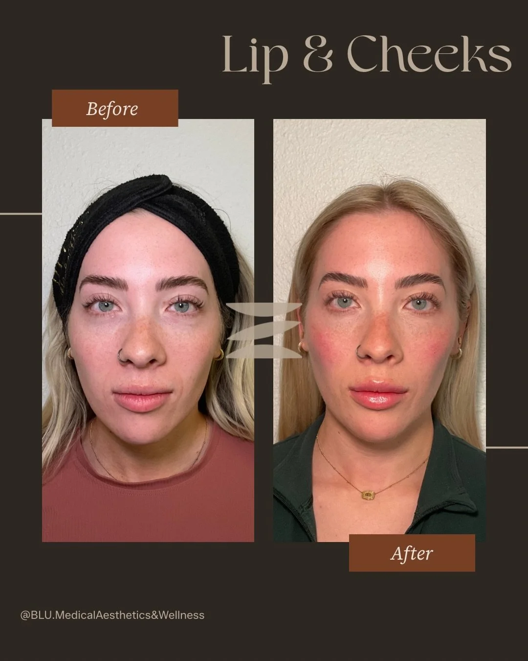 Subtle volume. Balanced structure. Effortless glow.

Lips + cheeks aren&rsquo;t about adding&hellip; they&rsquo;re about harmonizing.
Enhancing your natural features, restoring volume, and creating that lifted, refreshed look&mdash;without ever looki