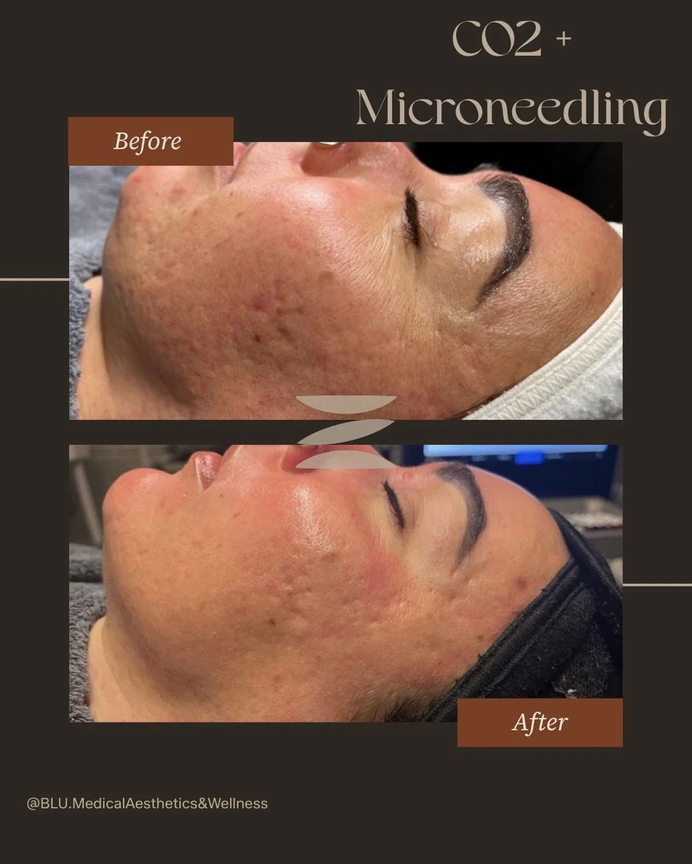 never one-size-fits-all ✨

This result is from strategically combining CO2 + Microneedling&mdash;because real skin correction happens when we treat multiple layers and mechanisms, not just the surface.

Think of it like this:
💥 CO2 targets deeper re