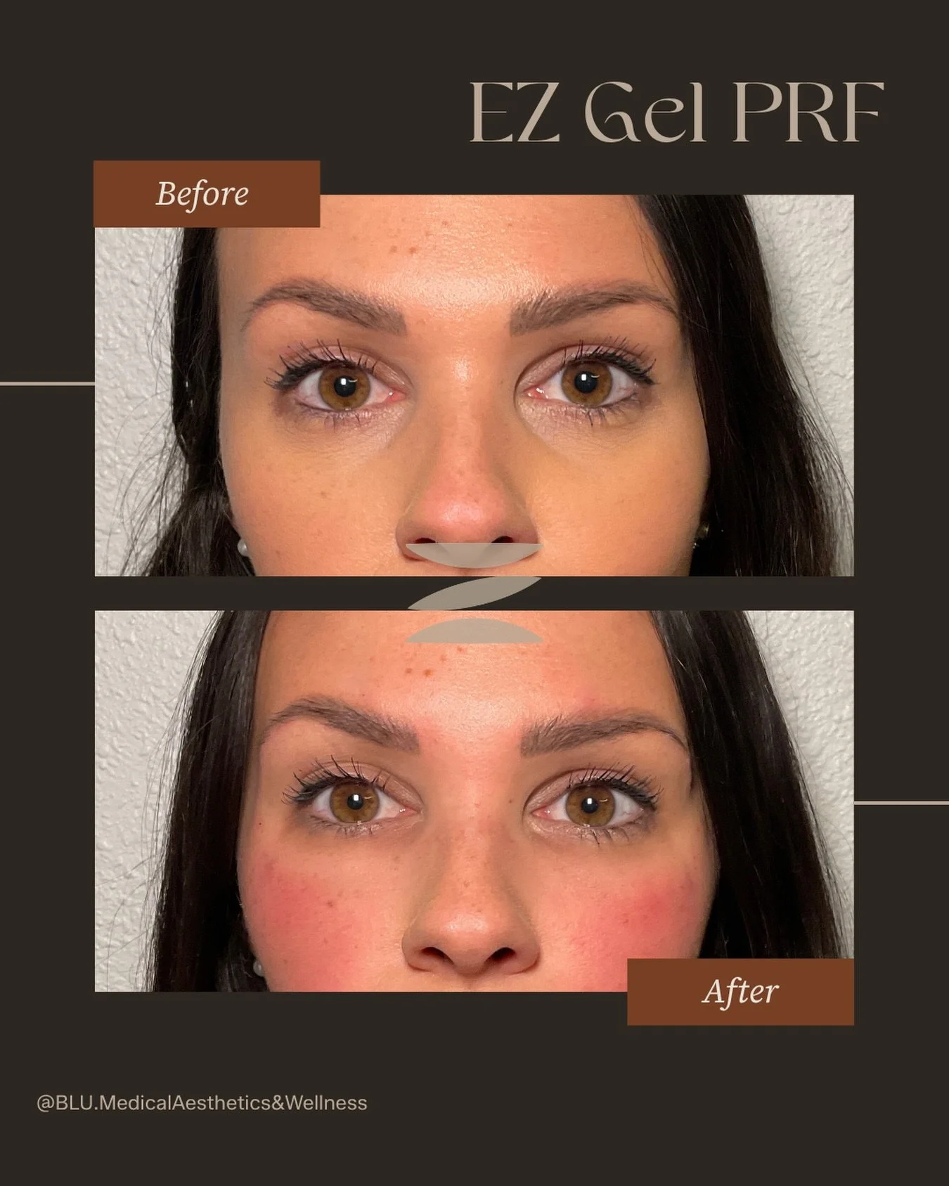Your body&hellip; your collagen&hellip; your results ✨

EZ Gel PRF is one of our favorite natural approaches to rejuvenating the under eye area&mdash;without traditional filler.

Unlike filler, EZ Gel is created using your own blood, spun and process