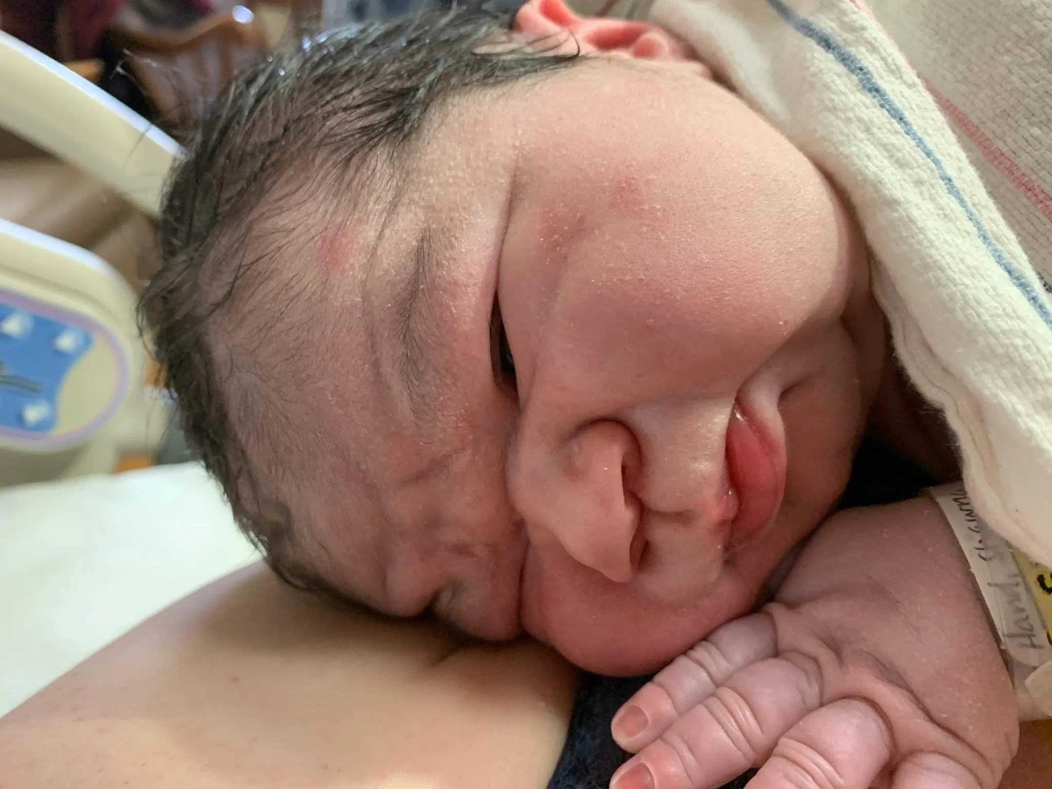 Close-up of a newborn baby resting on a person's arm with eyes closed, a small crack on the forehead, and a hospital bracelet visible.