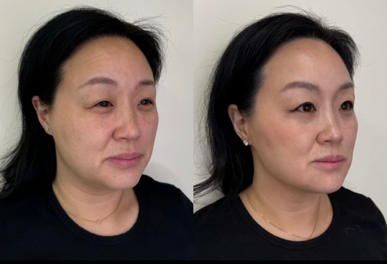 the_beauty_co_lab_home_before_and_after_filler_client.jpg