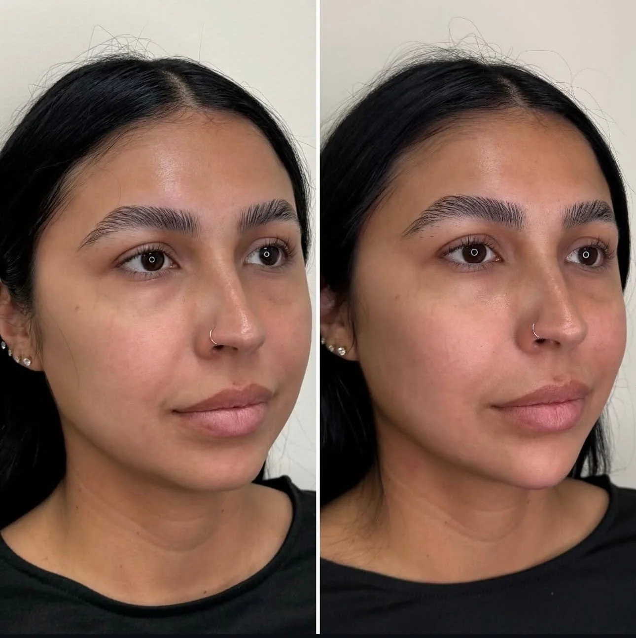 the_beauty_co_lab_home_before_and_after_filler.jpg