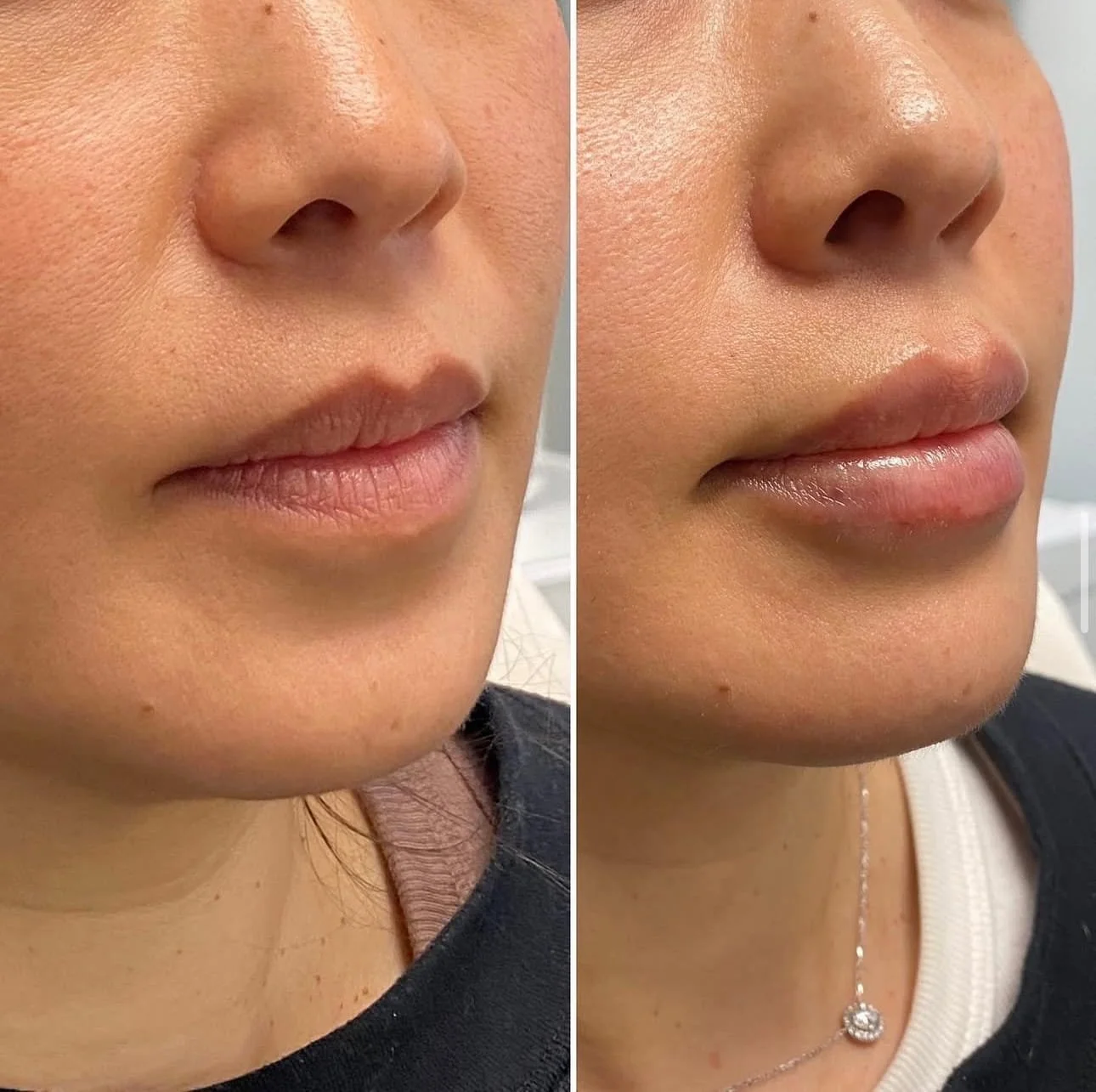 the_beauty_co_lab_home_before_and_after_lip_filler.jpg
