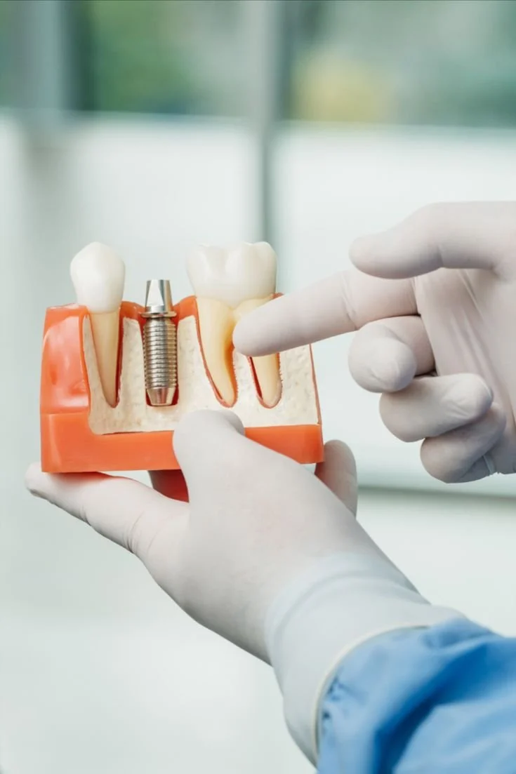 Modelo de dente com implante dentário, mostrando a estrutura óssea, dentes naturais e porcelana, com uma mão apontando para o implante.