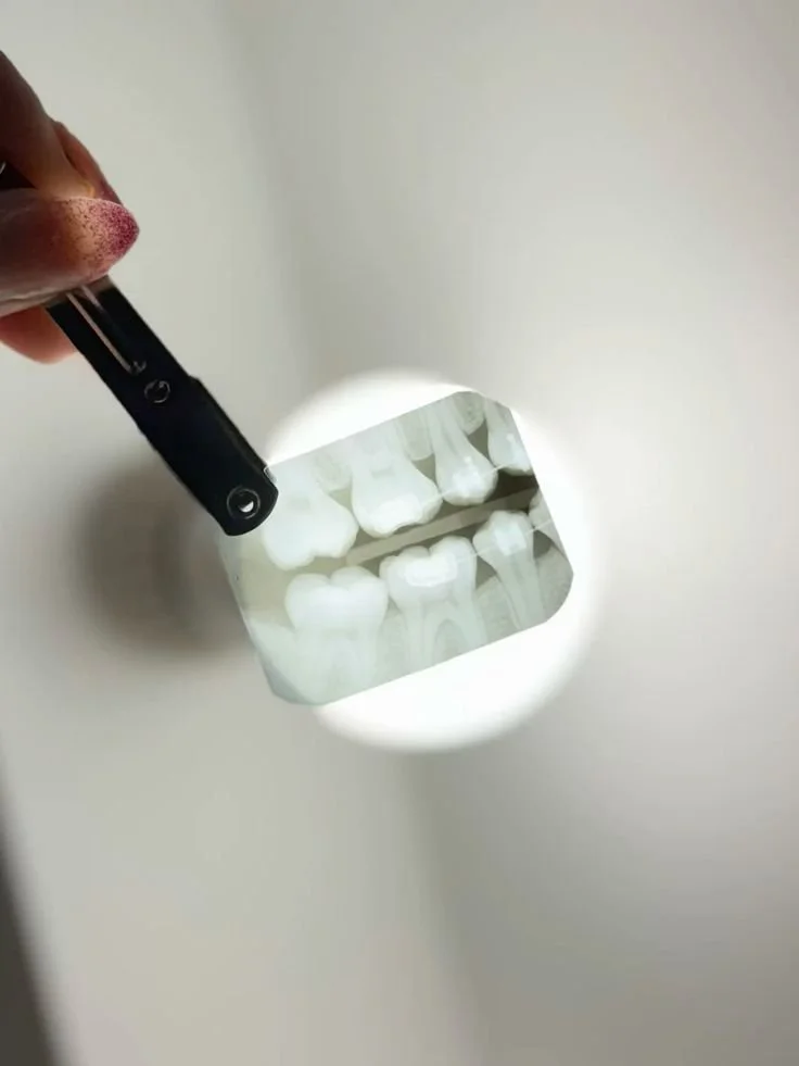 Raio-X de dentes mostrando dente superior e inferior com raízes visíveis.