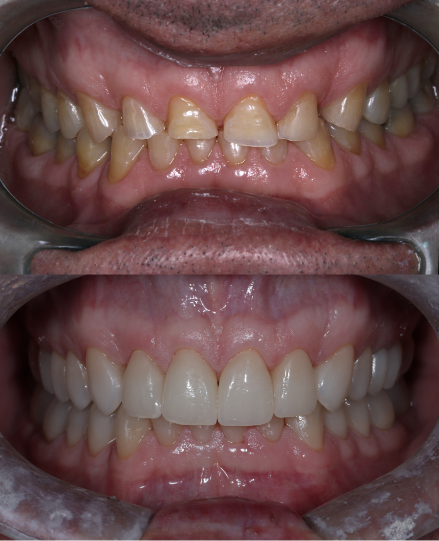 Bruxismo: por que o tratamento não pode focar só nos dentes