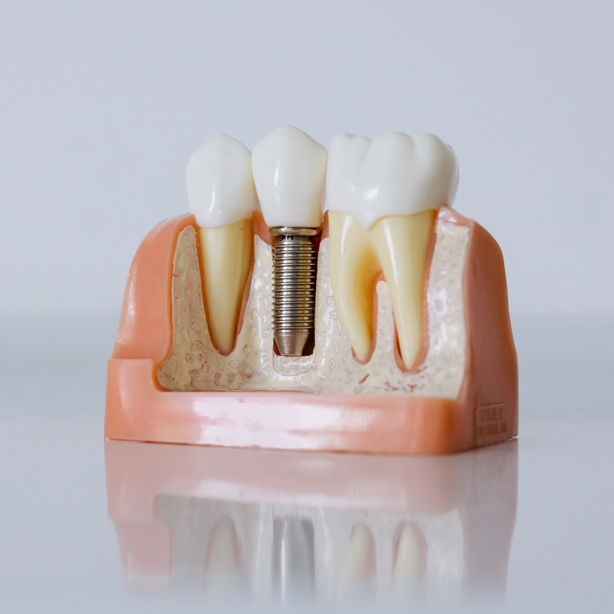 Customized Implant
