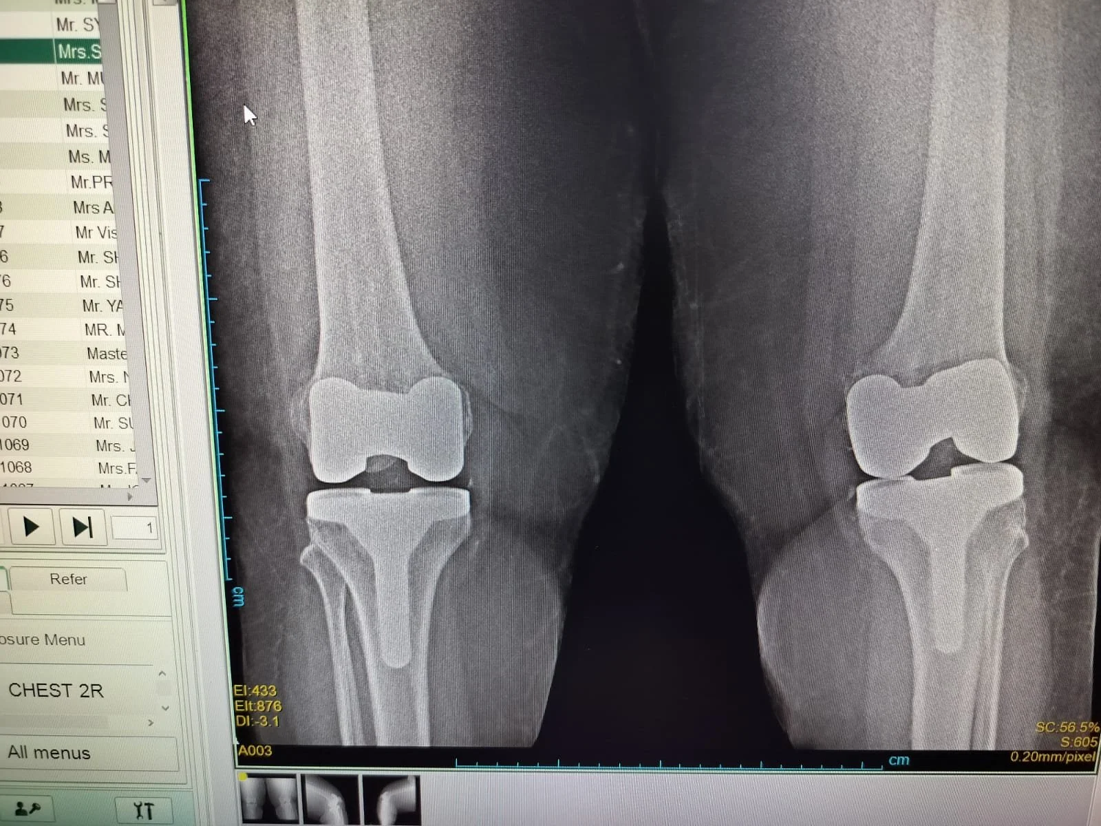 Bilateral Knee Replacement