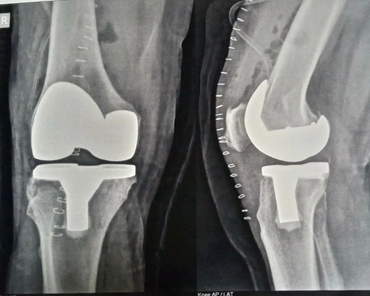 Total Knee Replacement