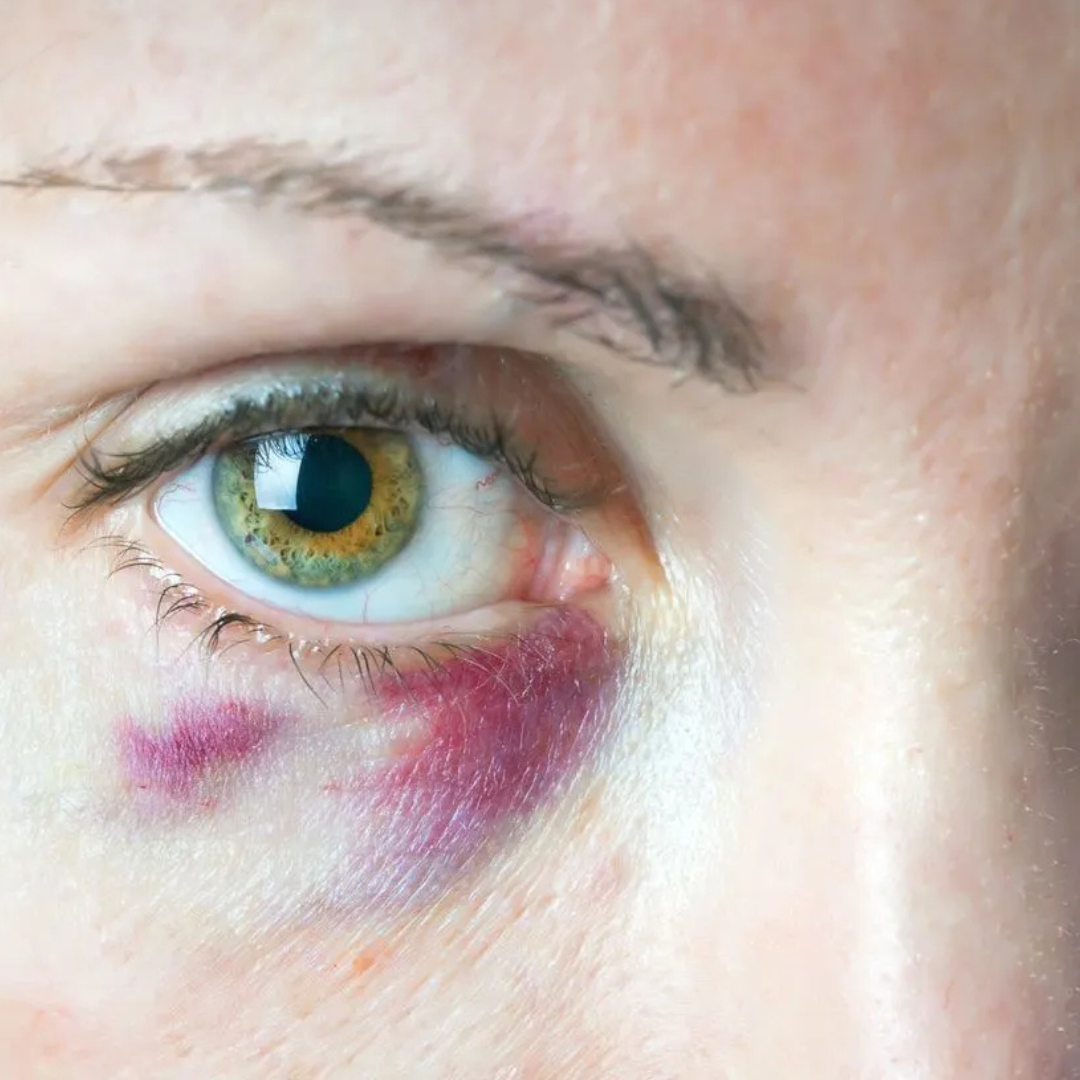 Understanding Bruising: Why Dark Patches Can Appear Under the Eyes After Treatment