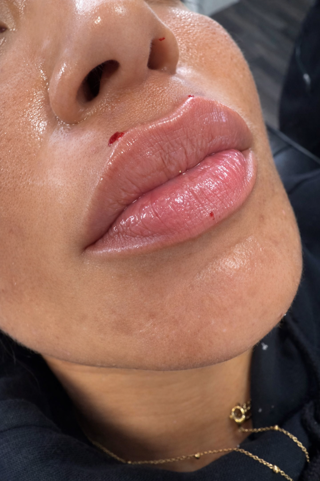 Close-up of a person's lips with minor cuts and blood, showing a nose and part of the chin, with skin that appears slightly flushed or oily.