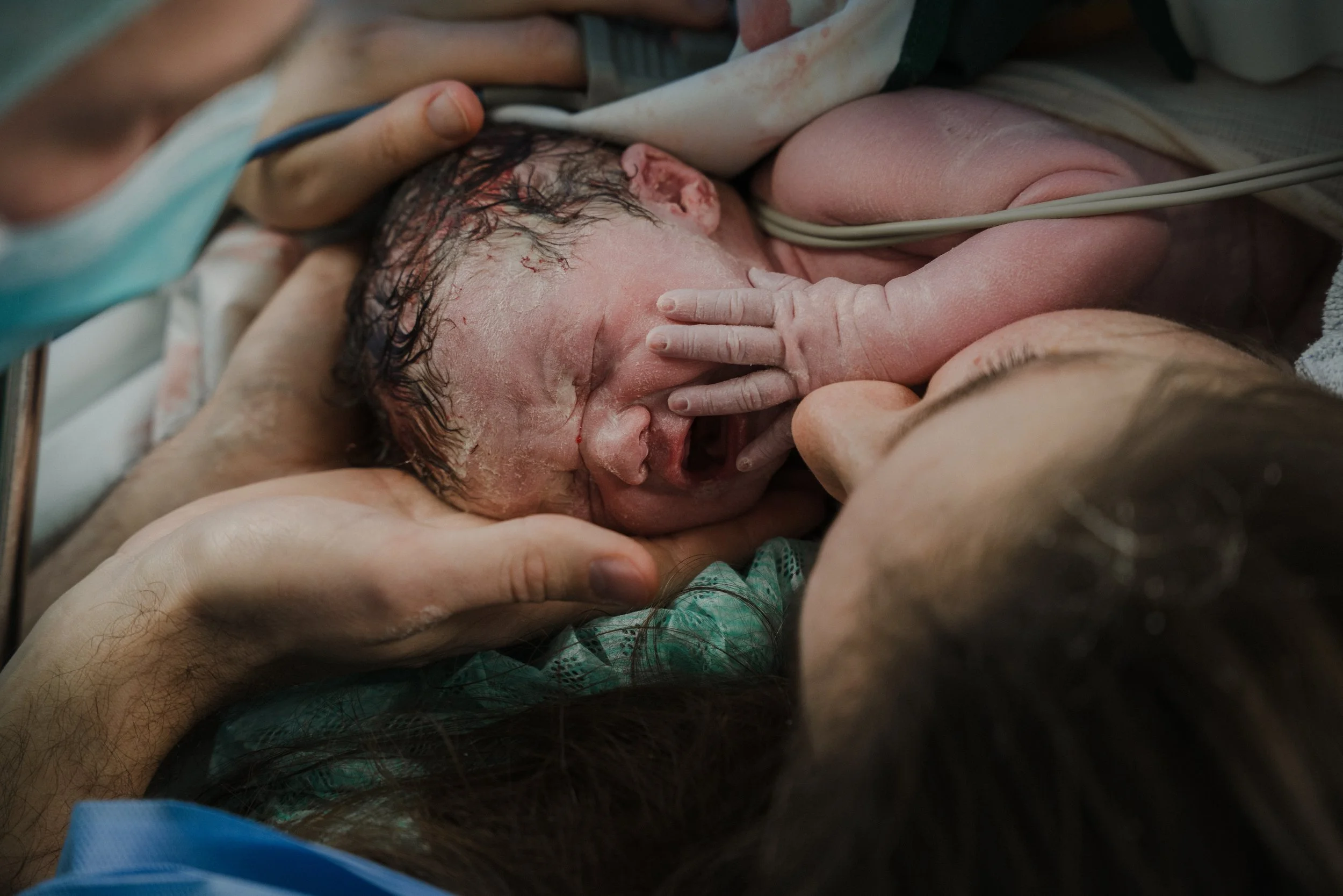 Ein neugeborenes Baby wird geboren, es liegt auf der Brust einer Frau, während medizinisches Personal hilft.