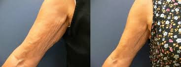 stretch mark arms 1.jpg