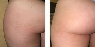 stretch marks butt.jpg