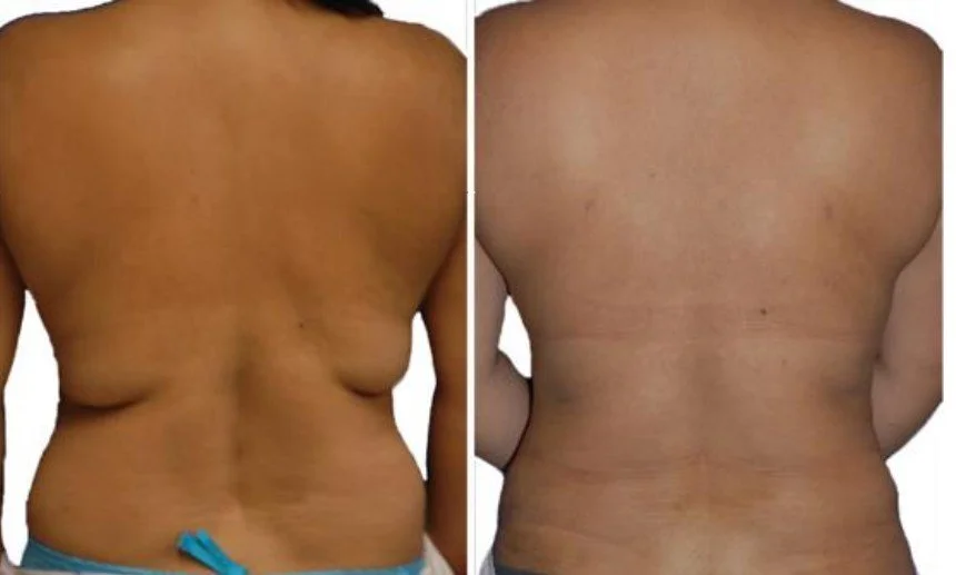 back fat loss transformation.jpg