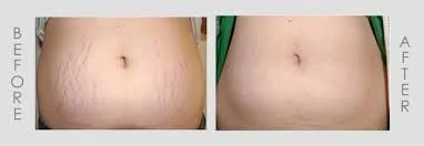 stretch marks stomach 2.jpg