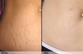 stretch marks stomach.jpg