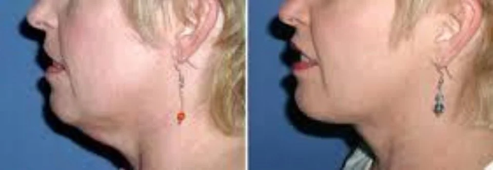neck transformation.jpg