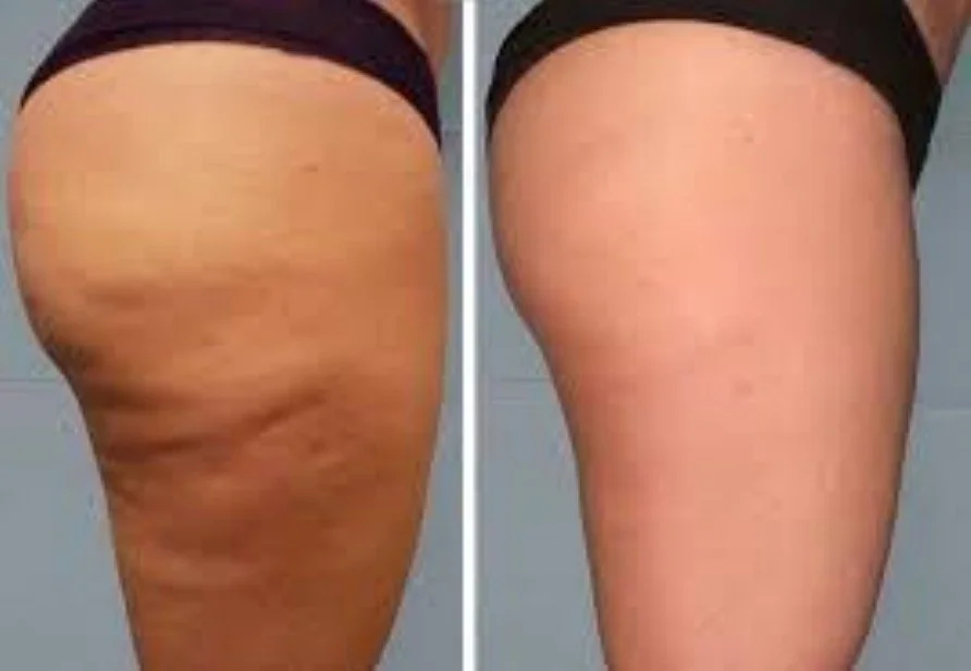 cellulite transformation.jpg