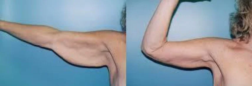 arm transformation.jpg