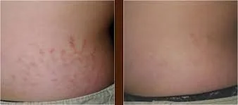 stretch marks side.jpg
