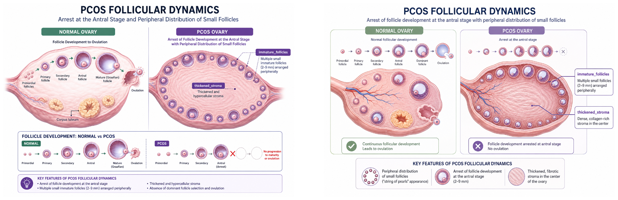 Diagram explaining PCOS follicular dynamics and follicle development stages, comparing normal ovary and PCOS ovary, with illustrations of follicle stages, immature follicles, thickened stroma, and key features.