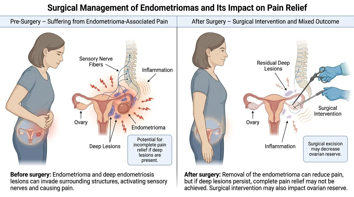 Does-surgery-for-endometriomas-relieve-suffering-Suffering-in-women-wi…-image-1.jpg