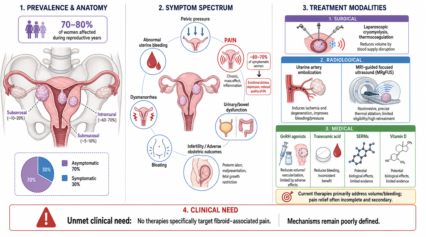 An infographic about fibroid-related issues, divided into four sections: 1. Prevalence and anatomy showing 70-80% of women affected during reproductive years, with diagrams of the uterus. 2. Symptom spectrum depicting pelvic pressure causing pain, ab