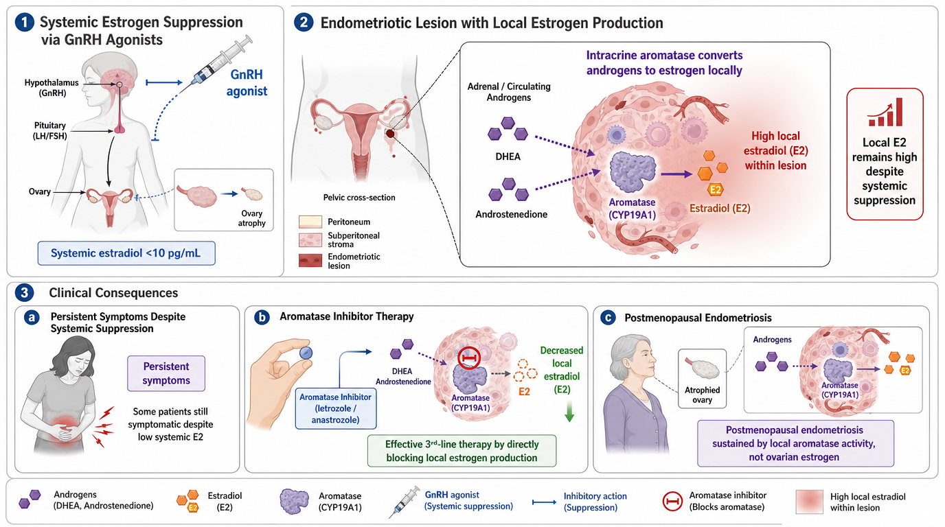 Infographic explaining endometriosis and related therapies. Sections show systemic estrogen suppression via GnRH agonist, endometriotic lesion with local estrogen production, clinical consequences like persistent symptoms and therapy options such as 