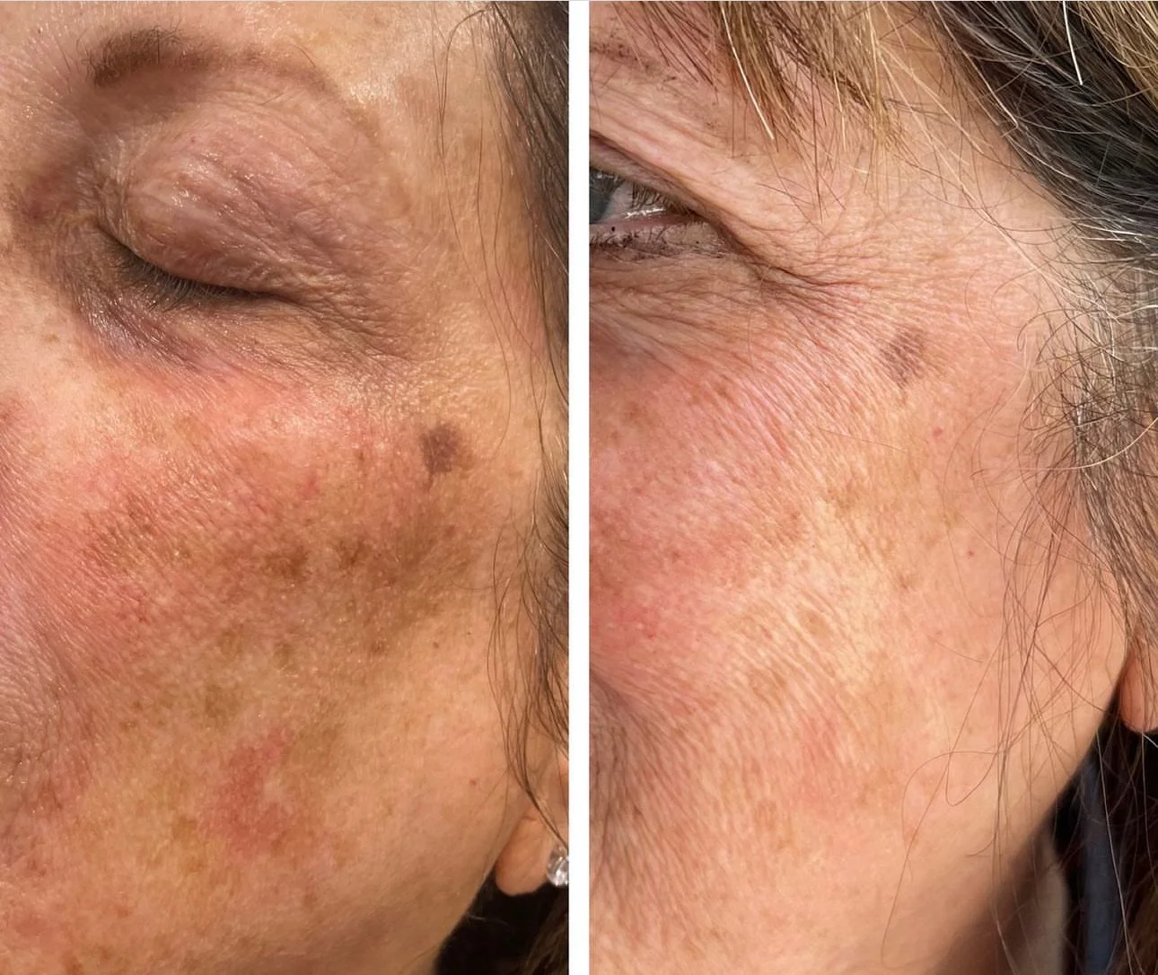 Medspa in Mentor, OH, 44060 | Moxi Laser Rejuvenation Near Me