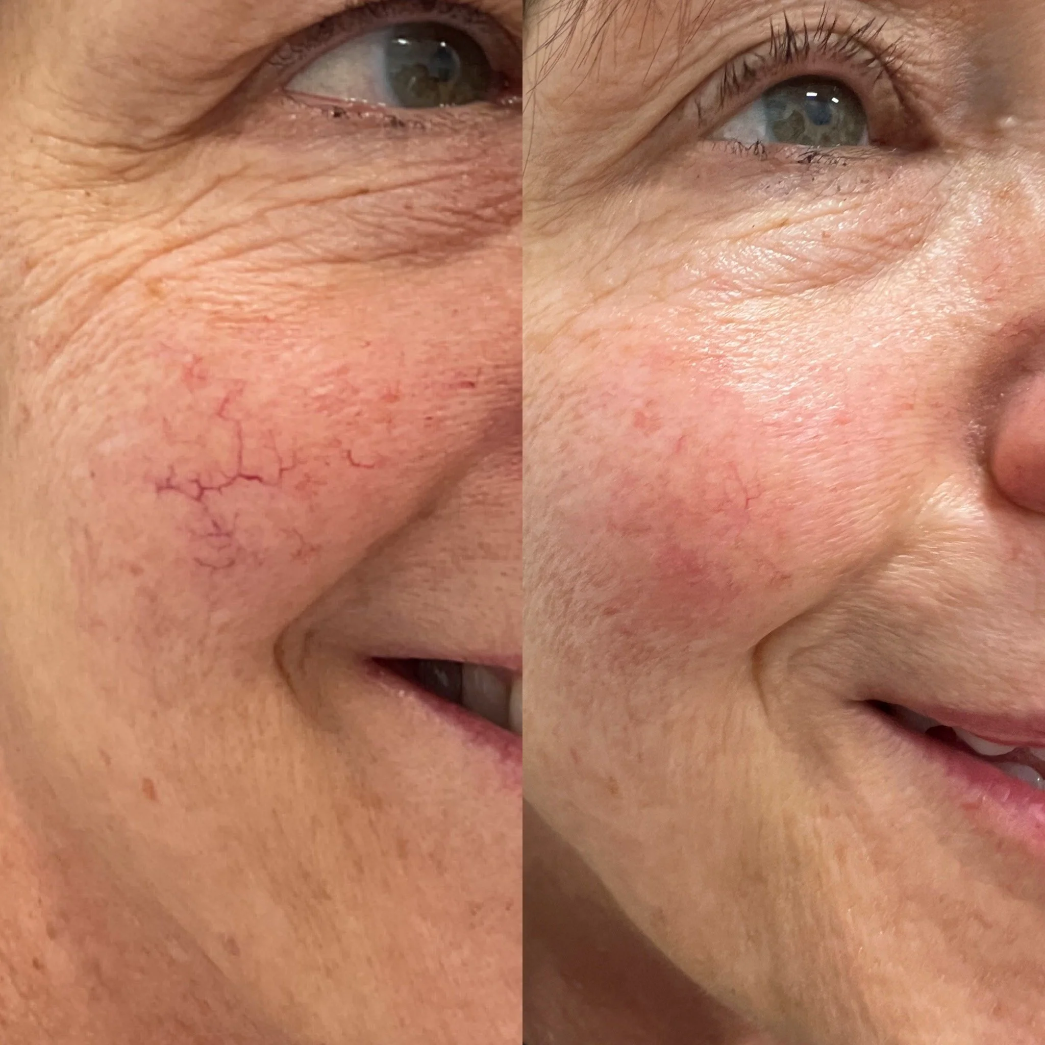 Medspa in Mentor, OH, 44060 | BBL Hero Light Therapy Near Me