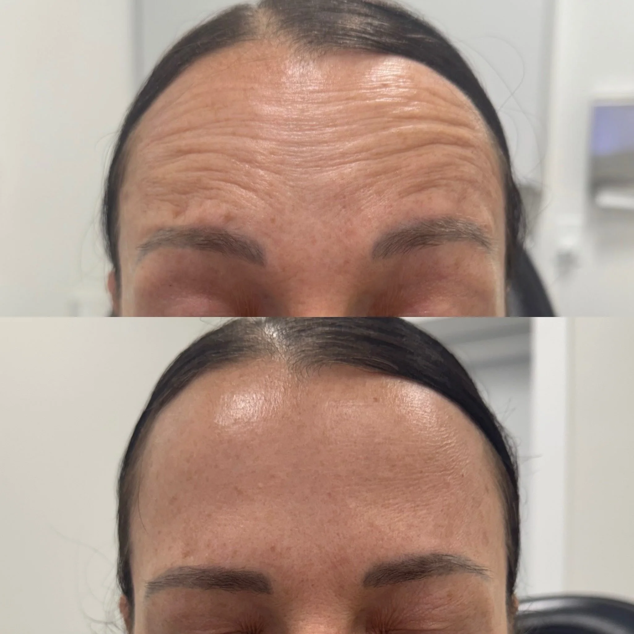 DAXXIFY for my &ldquo;no movement, please!&rdquo; girlies!

Daxxify ranks supreme among neurotoxins when it comes to firmness, texture improvement, and eliminating wrinkles 💉

Daxxify is also the only neurotoxin with a peptide formulation to create 