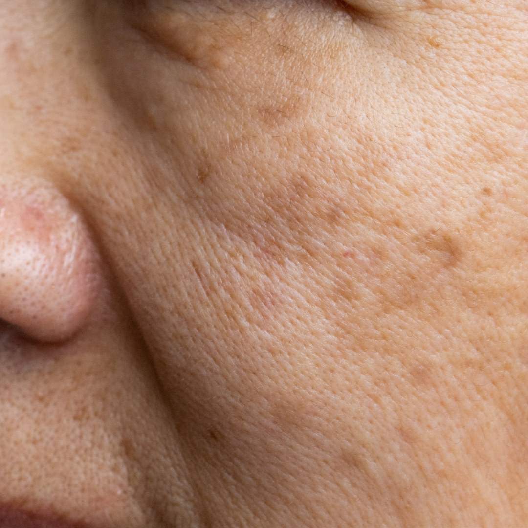 Conditions we Treat | Pigmentation | Lucy's Laser and Medspa