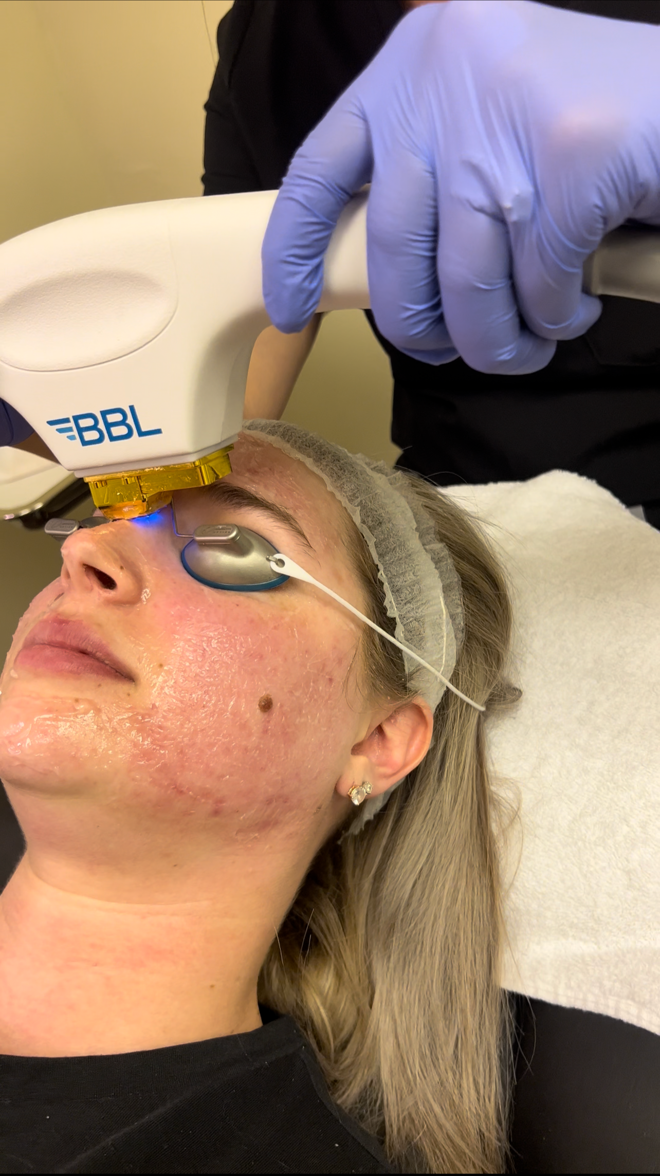 Medspa in Mentor, OH, 44060 | BBL Hero Acne Treatment Near Me