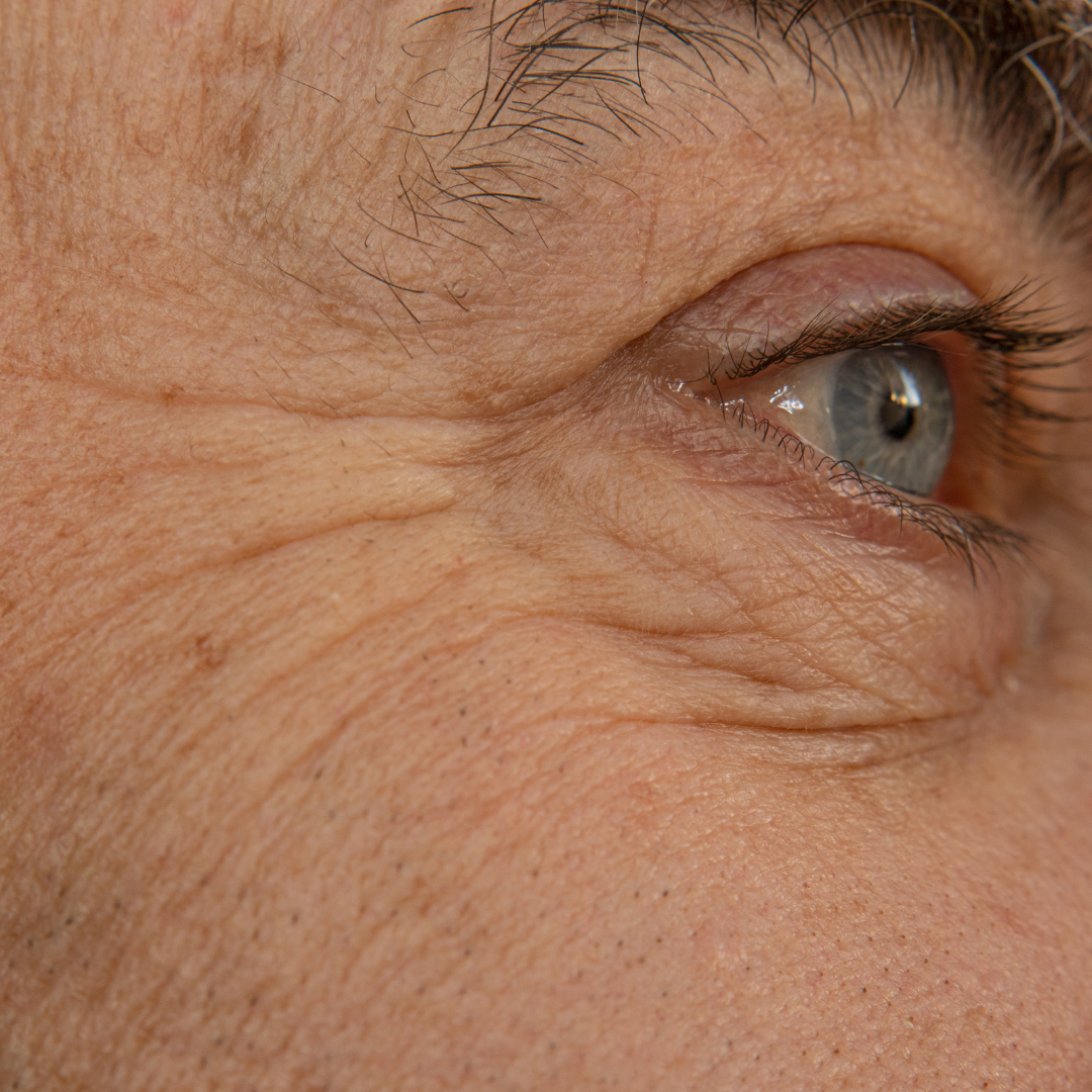 Conditions we Treat | Wrinkles | Lucy's Laser and Medspa
