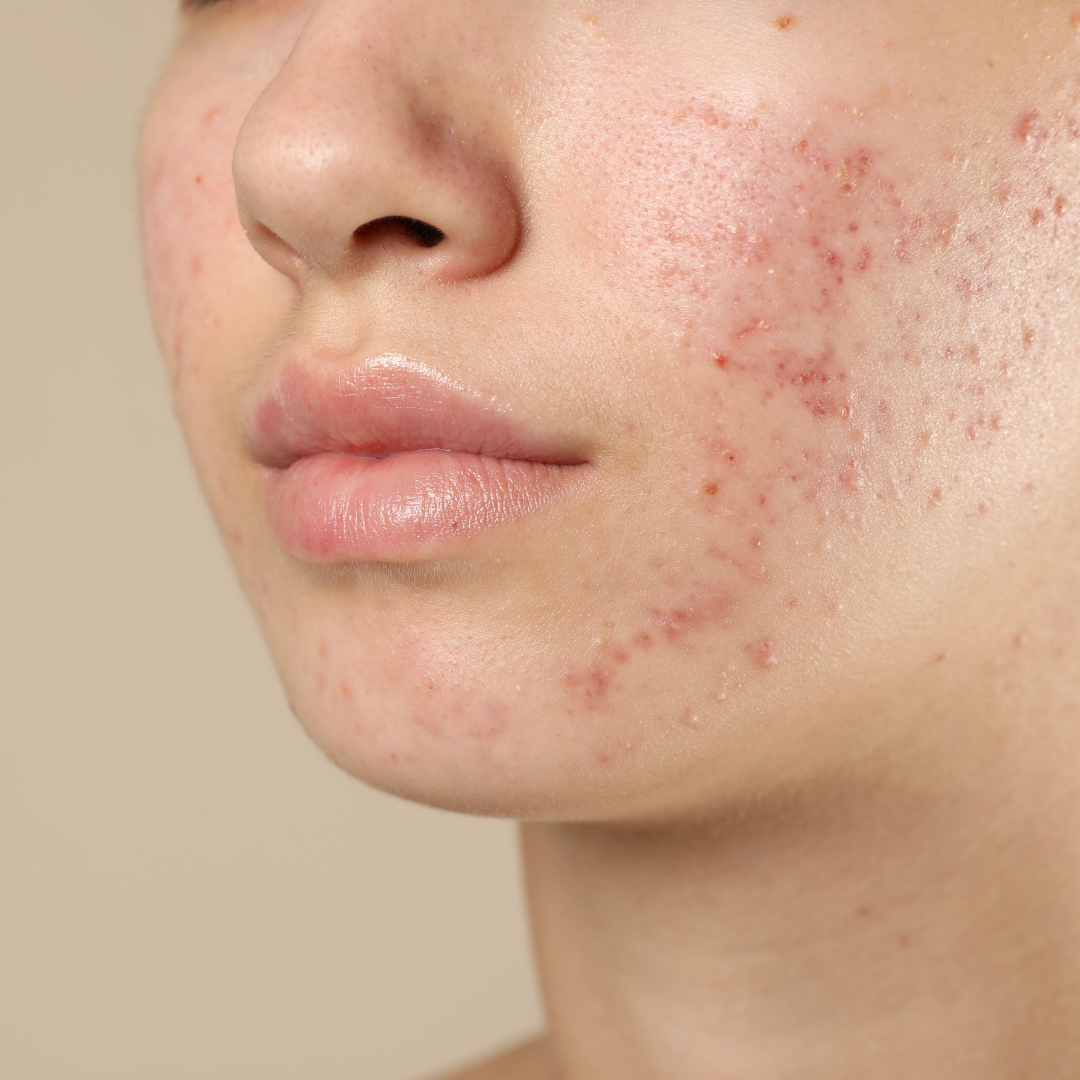 Conditions we Treat | Acne | Lucy's Laser and Medspa