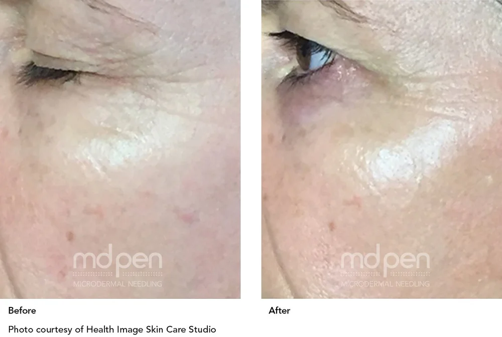 Before and after fine lines around the eyes with MDPen microneedling