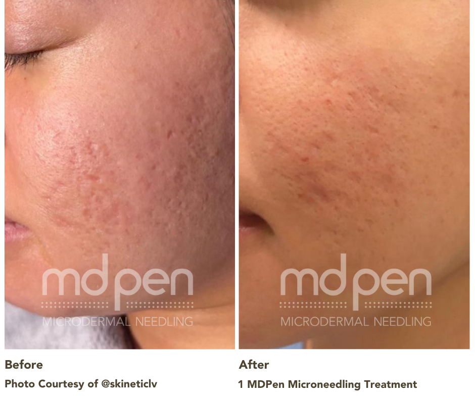 Before and after acne scar treatment with MDPen microneedling