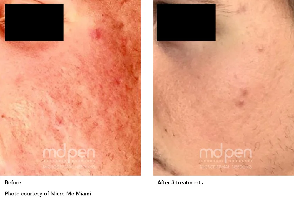 Before and after active acne and texture treatment with MDPen