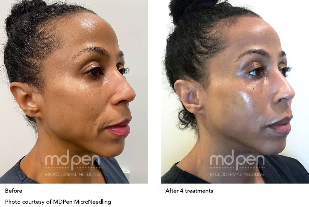 Before and after full face tone and elasticity with MDPen microneedling