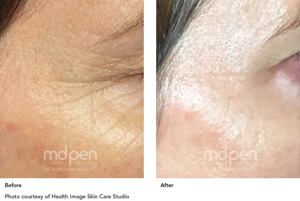 Before and after temple and eye area fine lines with MDPen